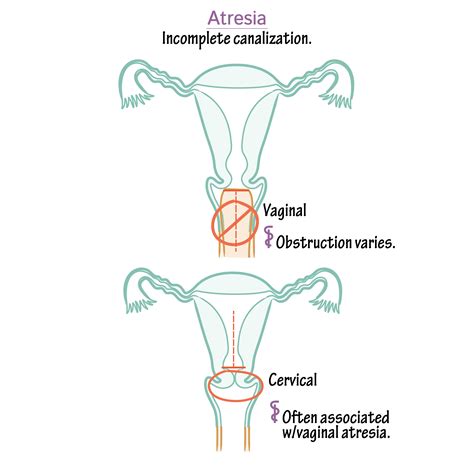 Embryology Glossary Congenital Vaginal And Cervical Atresia Draw It To Know It