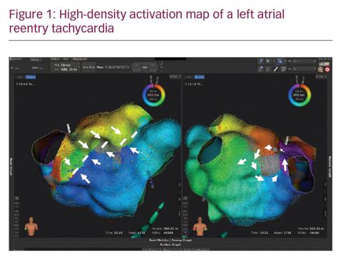 Types Of Electroanatomical Maps Qith Rhythmia