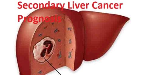 Deal With Secondary Liver Cancer Prognosis