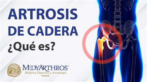 Artrosis De Cadera Qu Es Parte Cl Nica De Cadera Medyarthros