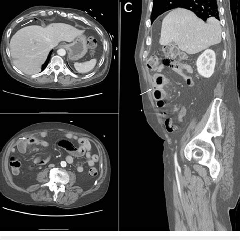 Ct Of The Abdomen And Pelvis With Iv Contrast A Axial View Showing Download Scientific