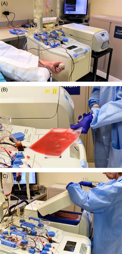 Pilot study of a new online extracorporeal photopheresis system in