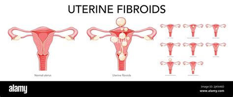 Set Of Uterine Fibroids Female Leiomyomas Reproductive System Uterus