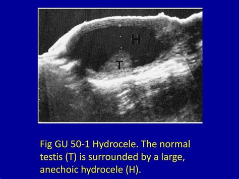 50 Fluid Collection In The Scrotum Ppt