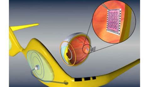 Artificial Retinas May Restore Partial Sight For Thousands In The Next Decade Nsf National