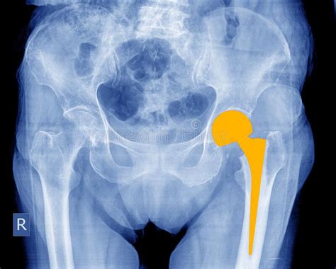 Complete Hip Implant Surgery X Ray Scan Image Of Hip Joints With