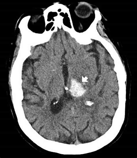 Brain hemorrhage causes, types, symptoms, diagnosis & treatment