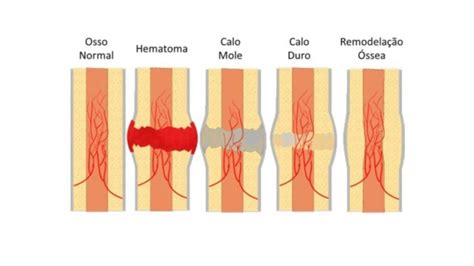 Fratura Osso Cola Mais Forte Ou Fraco Medicina Ortop Dica
