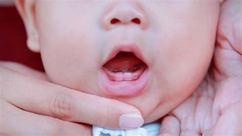 Caries infantil cómo detectarla y prevenirla ARCdental