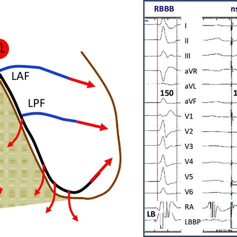 Atrioventricular Junction Ablation And Left Bundle Branch Pacing