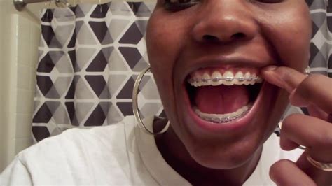 Adult Braces Update 6 Permanent Retainer Youtube