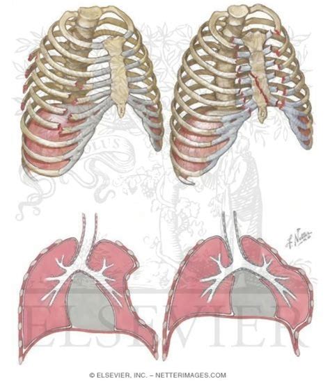 Flail Chest Diagram