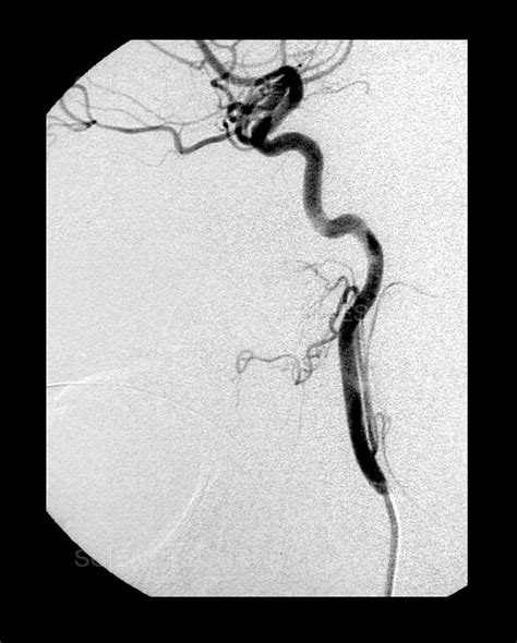 Photograph | Internal Carotid Artery, Angiogram | Science Source Images