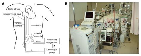 Extracorporeal Cpr