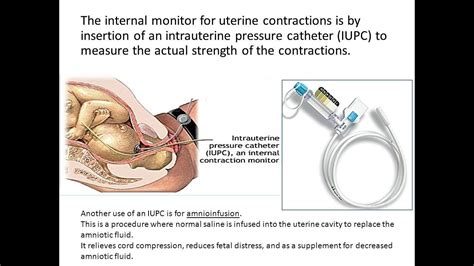 Fetal Monitoring: Interventions - YouTube