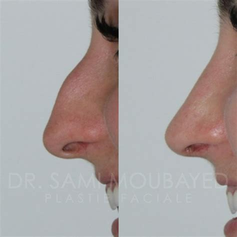 Rhinoplastie Ultrasonique Montr Al Clinique Face Md Rhinoplastie