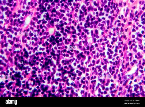 Hodgkins Lymphoma Light Micrograph Photo Under Microscope Stock