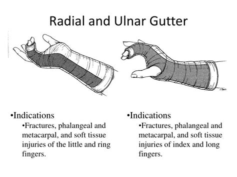 Ppt Splinting Workshop Broward General Medical Center Powerpoint Presentation Id4294994