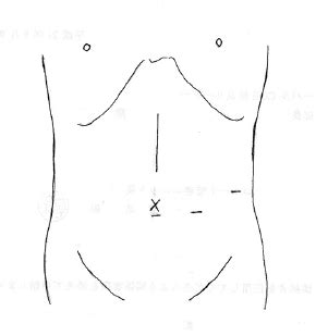 Skin Incision And Port Insertion Sites With HALS The Vertical Line Is