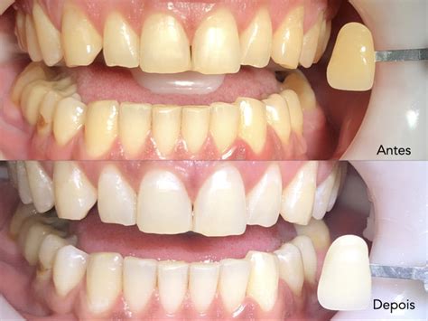 Em Busca Do Sorriso Ideal Voc Precisa Conhecer O Clareamento Dr