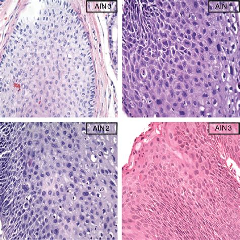 Pdf Prevalence Of Anal Intraepithelial Neoplasia Defined By Anal The