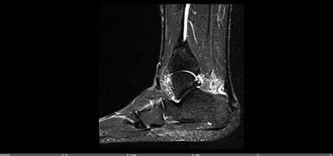 Insertional Achilles Calcific Tendonitis — Chicago Foot And Ankle Orthopaedic Surgeons