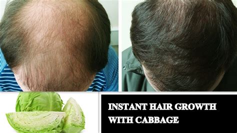 How To Treat Baldness And Regrow Hair On Bald Spots For Men And Women