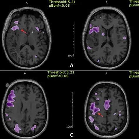 Procedure of Functional MRI - Ganesh Diagnostic