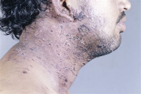 Skin Lesions Hiv