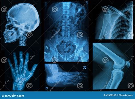 拼贴画x射线辐射人的图象 库存照片 图片 包括有 头骨 骨头的 英尺 图象 修复 女主持人 脖子 42658908