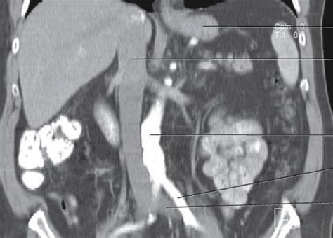 Diagram Of Coronal Abdomen 3 Quizlet