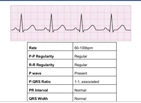 Ekgs Flashcards Quizlet