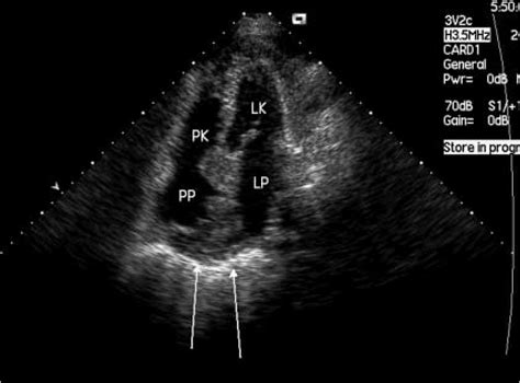 Transthoracic Echocardiography Apical 4 Chamber View Marked Irregular