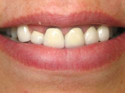 All Ceramic Crowns Northgate Dental