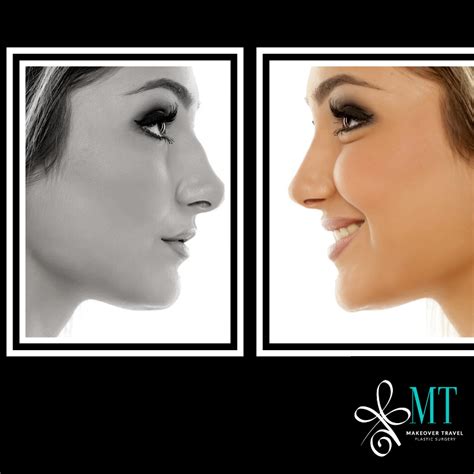 Plastic Surgery Before and After Photos - Cosmetic Surgery Vacation Packages