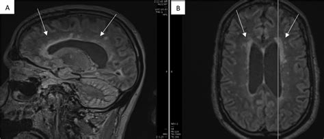 Sagittal A And Axial B T Flair Mri Images With Slice Localization