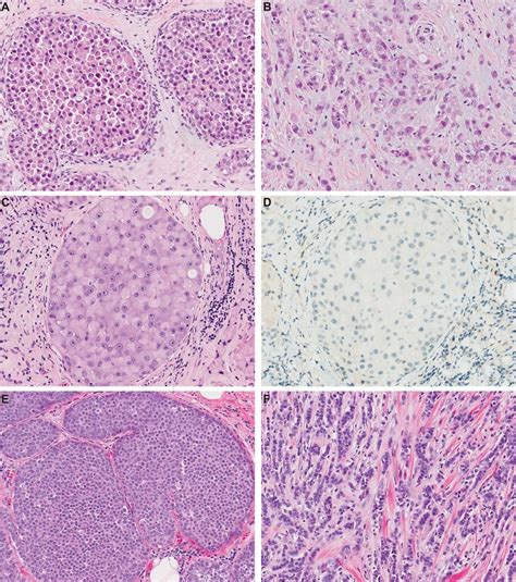 Genetic Analysis Of Pleomorphic And Florid Lobular Carcinoma In Situ