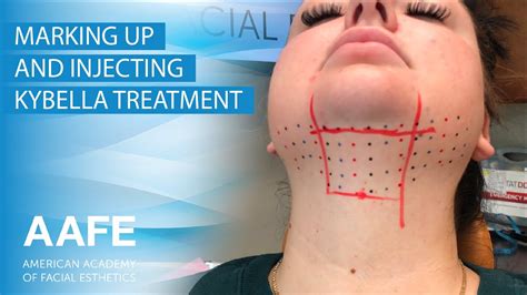 Marking Up And Injecting Kybella YouTube