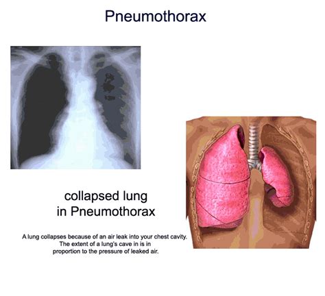 Nursing Diagnosis Nursing Diagnosis For Pneumothorax