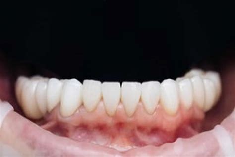 Composite Veneers Melbourne Dental Bonding [free Consultant]