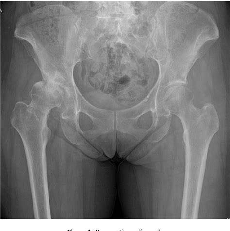 Figure From Early Intraprosthetic Dislocation After Closed Reduction