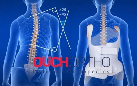 Scoliosis Brace Guide: Choose the best Brace in Dallas Ft. Worth