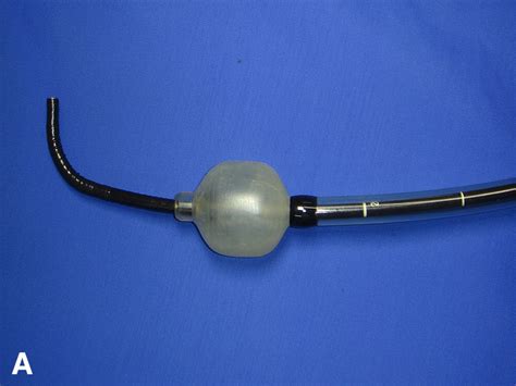 Overtube Balloonassisted Direct Peroral Cholangioscopy By Using An