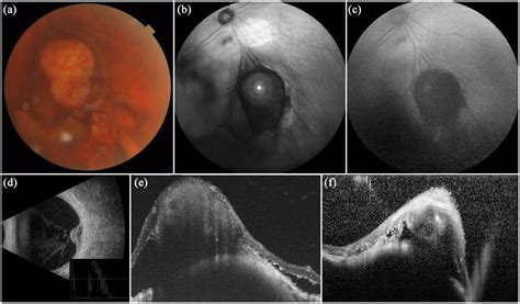 Amelanotic Choroidal Melanoma