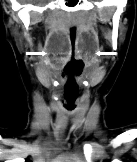 Coronal computed tomography (CT) scan of the neck with intravenous... | Download Scientific Diagram