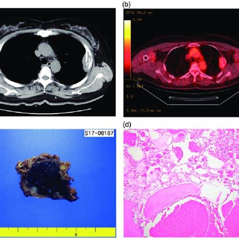 A Chest Computed Tomography Demonstrates An Expansile Osteolytic Download Scientific Diagram