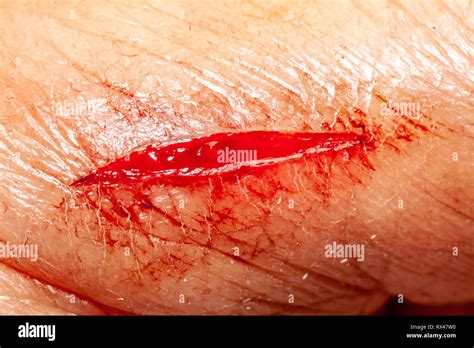 Hand Cut Blood Bleeding Hi Res Stock Photography And Images Alamy