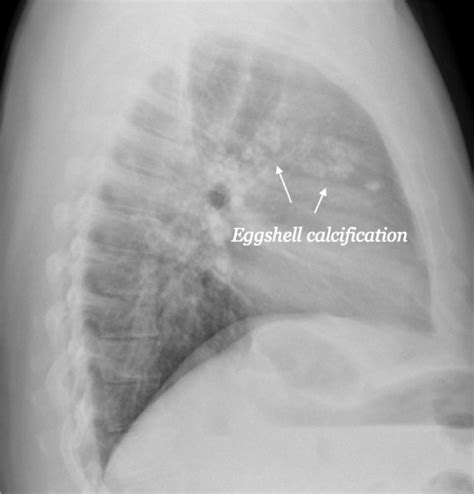 [figure Eggshell Calcification Of Hilar Lymph ] Statpearls Ncbi