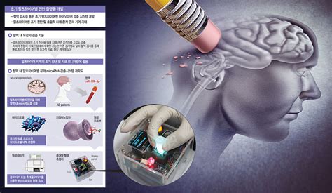 노년의 불청객 치매혈액검사만으로 조기진단 길 열렸다 네이트 뉴스