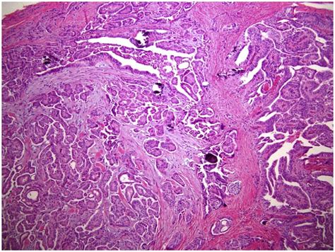 Serous Carcinoma Of The Testicle And The Paratesticular Tissue Case